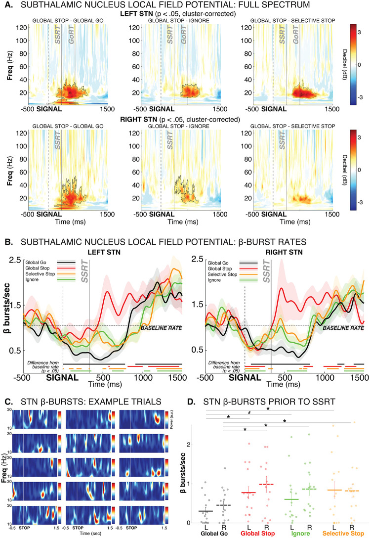 SSRT result: The plot shows subthalamic nucleus dynamics during selective and non-selective stopping